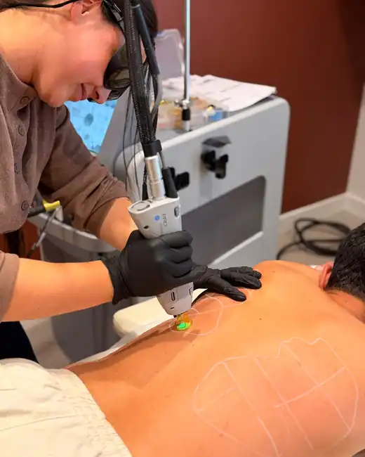 Séance d’épilation laser sur le dos