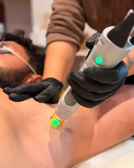 Application du laser sur une zone ciblée